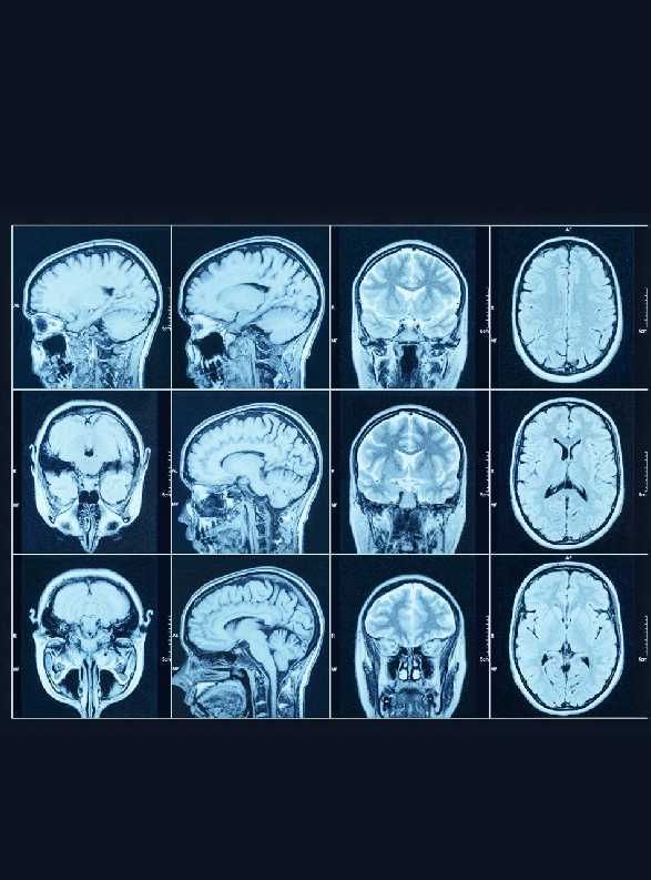 FDG Brain PET-CT Scan in Lucknow